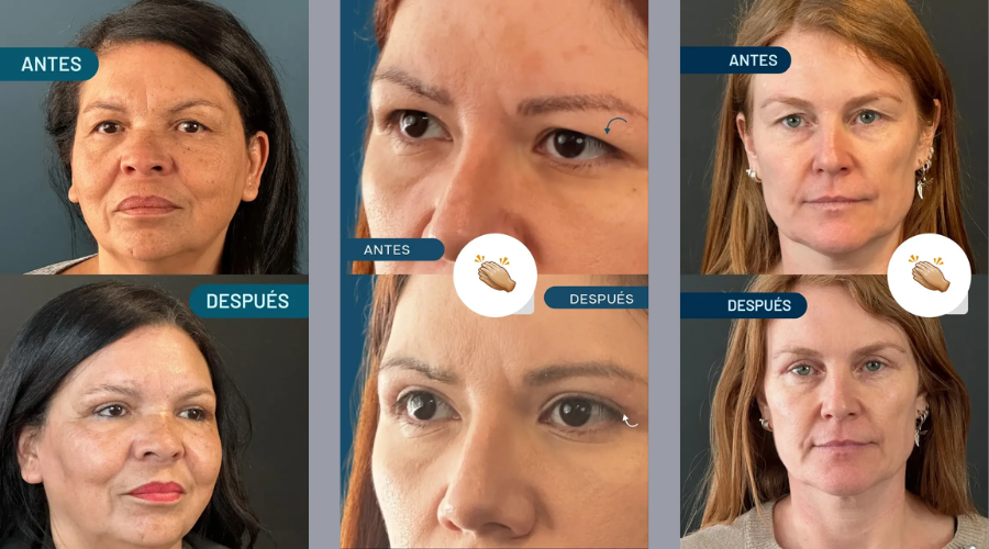 Blefaroplastia Full Láser Blefaroplastia Full Láser